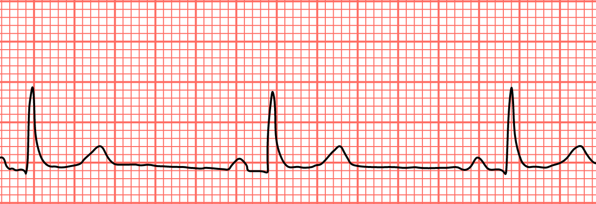 Decreased heart rate